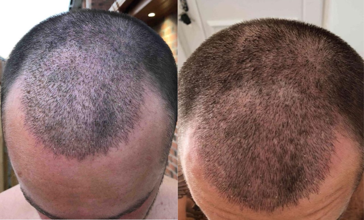 Hair Transplant London: Westminster Medical Group®’s Expert Approach