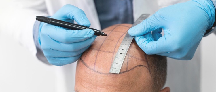 Hair Transplant Istanbul: 2025 Trends in Hair Restoration