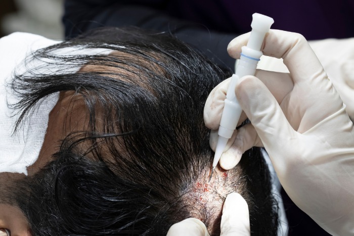 Hair Transplant Turkey Procedures at Sapphire Hair Clinic